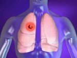 Врачи: Стволовые клетки – ключ к лечению рака лёгких